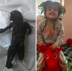 حكاية صورة: حين كشفت الطفلة المتفحمة "ليان" حقيقة إرهاب الحوثي وغياب الضمير الإنساني لغريفيث